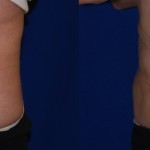 coolsculpting before and after Sonoma County