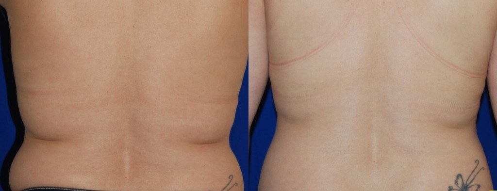coolsculpting before and after woman's back