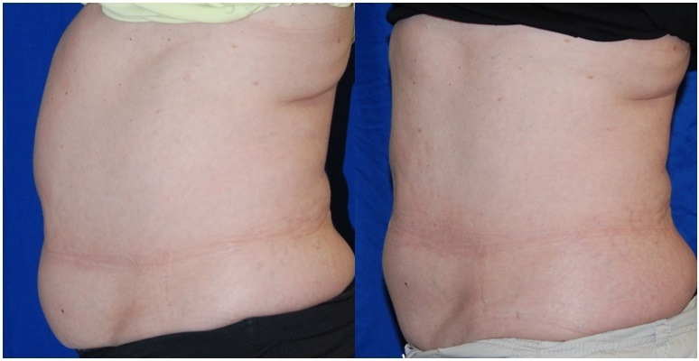 coolsculpting before and after