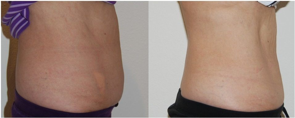 coolsculpting before and after stomach area