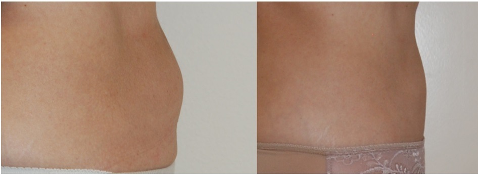 coolsculpting before and after