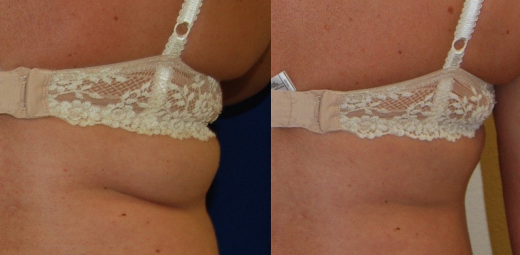 coolsculpting before and after upper back woman