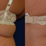 coolsculpting before and after upper back woman