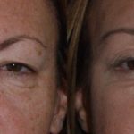 woman's face before and after Eyelid Surgery showing less excess skin