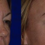 woman's face before and after Eyelid plastic surgery showing less excess skin