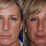 eyelid surgery before and after