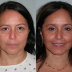 eyelid surgery before and after