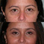 eyelid surgery before and after