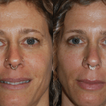 eyelid surgery before and after