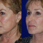 Facelift and Neck Lift before and after