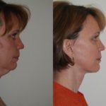 Facelift and Neck Lift before and after