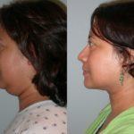 Facelift and Neck Lift before and after