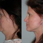 Facelift and Neck Lift before and after