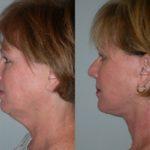 Facelift and Neck Lift before and after