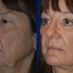 woman's face after facelift and neck lift showing tighter skin and contours