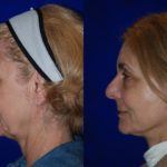 Facelift and Neck Lift before and after