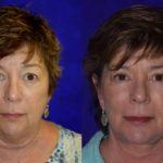Before and after woman's facelift and neck lift treatment showing tighter facial contours