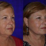 Before and after woman's facelift and neck lift treatment