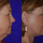 Before and after woman's facelift and neck lift treatment