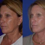 Before and after woman's facelift and neck lift treatment