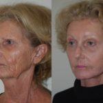 Facelift and Neck Lift before and after