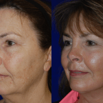 woman's face before and after injectable fillers before and after