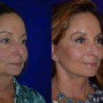 Before and after woman's facelift and neck lift treatment