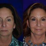 Before and after woman's facelift and neck lift treatment