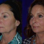 Before and after woman's facelift and neck lift treatment