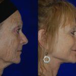 side profile of woman's face before and after neck lift showing tighter skin and contours