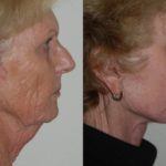 Facelift and Neck Lift before and after