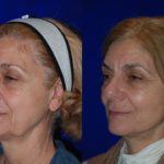 Facelift and Neck Lift before and after