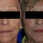 woman's face before and after injectable fillers