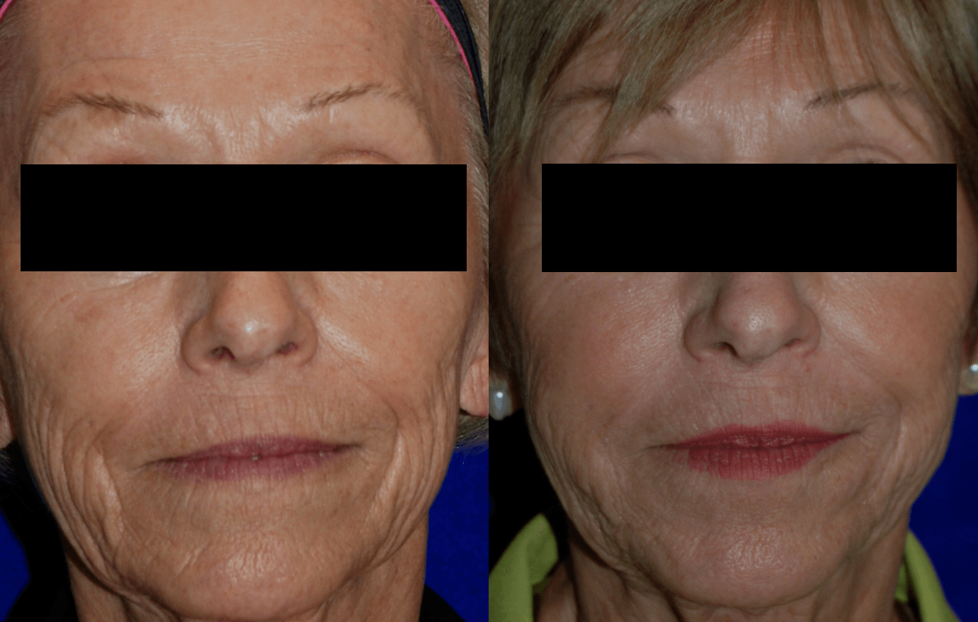 woman's face before and after injectable fillers