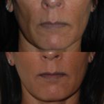 Injectable Fillers before and after