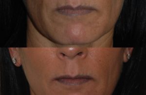 Injectable Fillers before and after