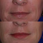 Injectable Fillers before and after