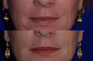 Injectable Fillers before and after