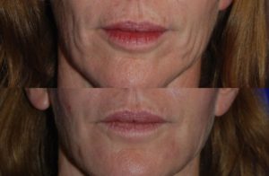 Injectable Fillers before and after