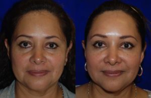 Injectable Fillers before and after
