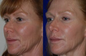 Injectable Fillers before and after