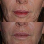 Injectable Fillers before and after