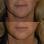 juvederm before and after