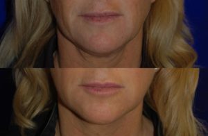 juvederm before and after