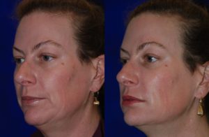 botox before and after