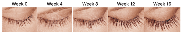 latisse eyelash treatment results week after week
