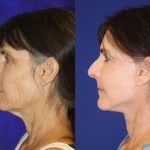 Before and after woman's facelift and neck lift treatment