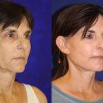 Before and after woman's facelift and neck lift treatment