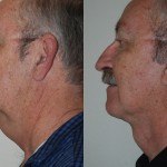 facelift and neck lift before and after