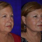 Before and after woman's facelift and neck lift treatment